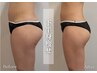 【美脚★美尻痩せ】下半身痩せ/セル脂肪撃退20代～30代人気 2回体験12,800円