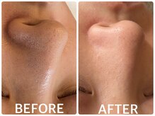 ハーブピーリング 恵比寿/毛穴/角栓/小鼻毛穴