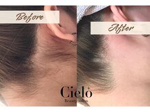 シエロ 川崎店(Cielo)/うなじ脱毛