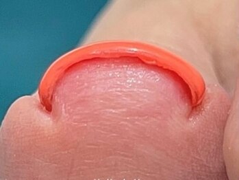 ペロ 名古屋(pelo)の写真/どこに行っても改善されなかった爪の悩みを根本改善【巻き爪矯正ワンカラー¥14000】プロによるケアで美爪に