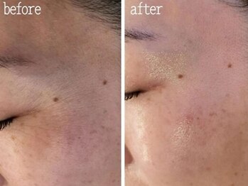 ファルファラ(farfara)/天然ハーブピーリング