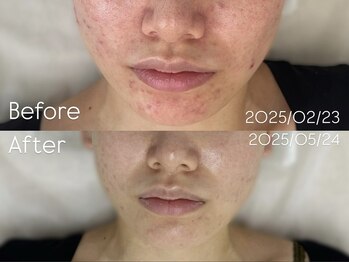 アンリミット 下北沢店(Une limit)/【お肌の赤みにお悩みの方へ】