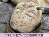 ニキビケア//毛穴//小顔//凸凹改善⇒ 微細針 ¥12800先着10名様限定