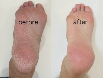 アンドエム(&M)の写真/【かかと角質ケア+フットジェル¥6990~】乾燥や摩擦で硬くなったかかとをケア◎ガサガサかかともツルツルに*