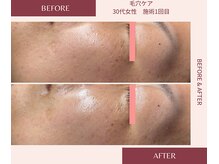 ウェルネス ステーション リンク(Wellness Station Link)/【毛穴ケア】ビフォーアフター