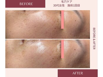 ウェルネス ステーション リンク(Wellness Station Link)/【毛穴ケア】ビフォーアフター