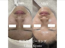 エステティック リベル キョウト 京都駅前店(Esthetic Liber Kyoto)/肌質改善ピーリング