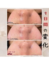 プルーム 久留米店(plume)/ハーブピーリング／肌荒れ