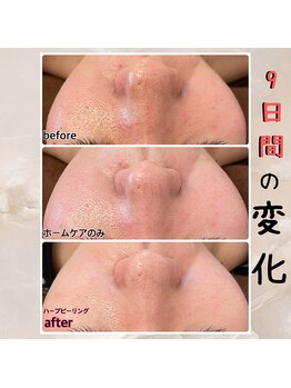 プルーム 久留米店(plume)/ハーブピーリング／肌荒れ