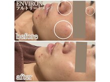 ギンザクリア 銀座本店(GINZA CLEAR)/肌荒れ鎮静/ターンオーバー促進