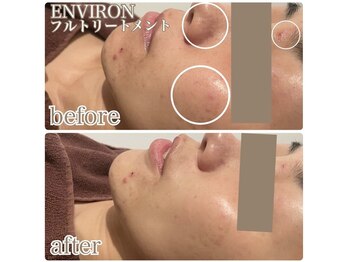 ギンザクリア 銀座本店(GINZA CLEAR)/肌荒れ鎮静/ターンオーバー促進