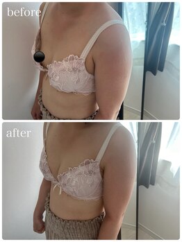 リノ 行橋(lino)/◇バストアップ症例◇30代