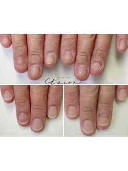 爪の悩みを解消できる（ケア含む）