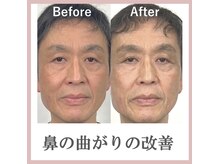 ラプリボヤージュ 藤沢店(Raplit)/ 隆鼻＋輪郭矯正40分10回コース