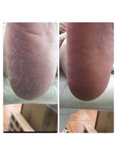 厚木 海老名 巻き爪矯正センター/事例【ドイツ式フットケア】