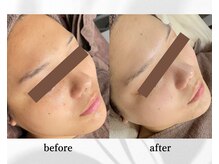 アン ビューティー(ann beauty)/【症例写真】20代女性