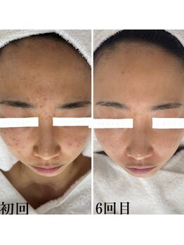 プラセル(Placer)/気になるニキビ・跡も