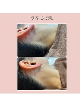 ノノ(nono)/うなじ脱毛