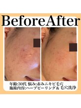 スイ(sui)/Before＆After