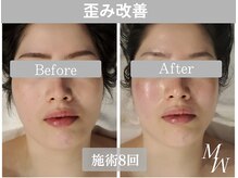 ミピマム 町田店/お顔の左右差を根本改善