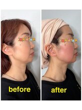 ブルースター(BLUE STAR)/オンダリフト【二重あご激変】