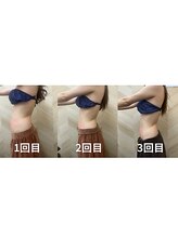 介正鍼灸整骨院 整体院 エフコープ大野城店/痩身エステ＊ラジオ波／キャビ