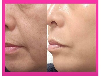 アン 銀座(ann)/たるみ/毛穴/ほうれい線/水光肌