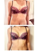 ソラ(SORA)/バストアップ症例