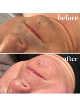 スピカ(Spica)/青ヒゲでお悩みの方にも効果◎!