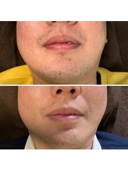 ティエル(TieLu)/ヒゲ脱毛