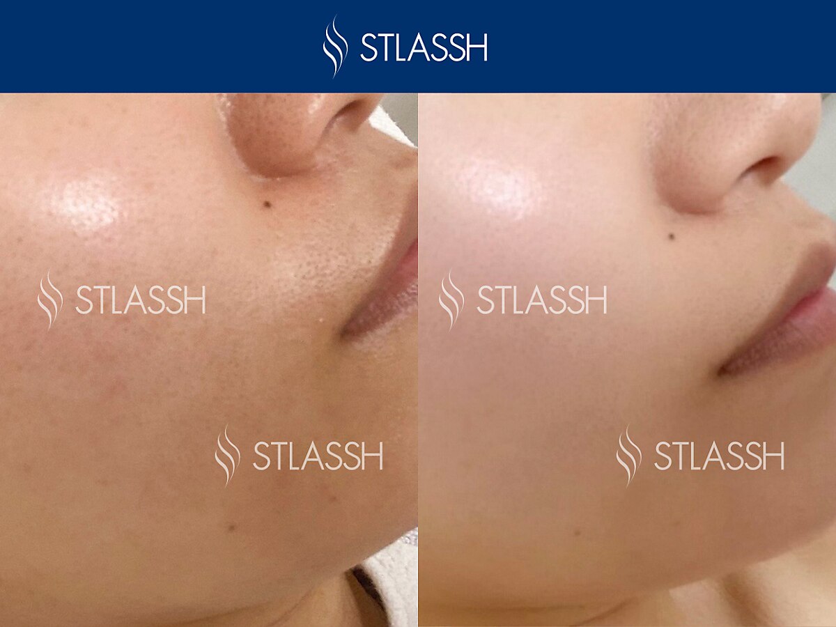 エレクトロポレーション　エステ 水戸市でエレクトロポレーションが人気のエステサロン