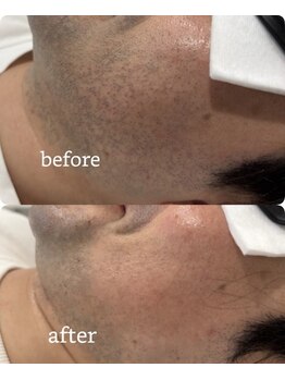 バベル(BABEL)/2回照射後のビフォーアフター☆