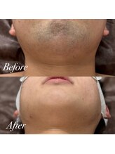 ボス 大曽根店(BOSS)/朝が変わる脱毛体験＃ヒゲ脱毛