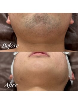 ボス 大曽根店(BOSS)/朝が変わる脱毛体験#ヒゲ脱毛