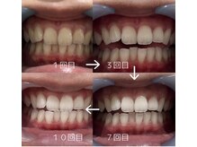 ホワイトニングショップ 加古川店/通えば通うほど白くなる！！