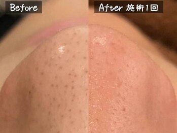 セレブリボーン 大阪ボーテ/ハイドロ毛穴洗浄