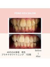 ポノケアサロン(PONO KEA SALON)/セルフ高濃度プラチナジェル使用