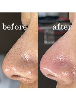 ティーツリー 名古屋 桜山(Tea Tree)/黒ずみはまず除去することが肝心