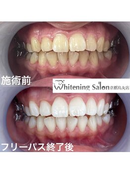 ホワイトニングサロン 京都烏丸店/ホワイトニング施術例