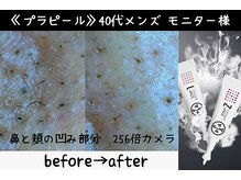 サロンスペース/水光肌【プラピール】モニター様