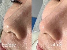 スキンラボ ドットシキブ 厚木海老名店(skinlabo .sikibu)/光フェイシャル＋毛穴洗浄コース