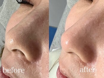 スキンラボ ドットシキブ 厚木海老名店(skinlabo .sikibu)/光フェイシャル＋毛穴洗浄コース