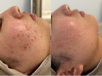 ピブ(PIBU)/思春期ニキビ/ハーブピーリング