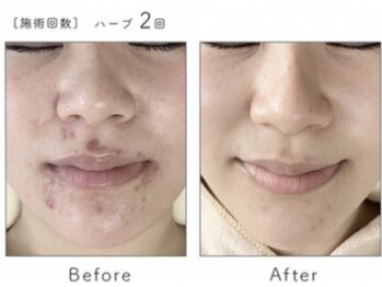 フローレント(Florent)/ハーブピーリング　