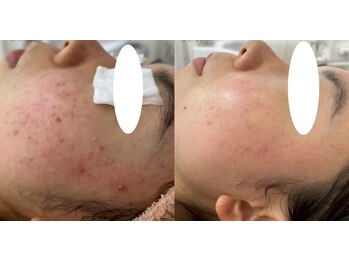 ミュー 多治見店(mieux)/◆肌質改善例