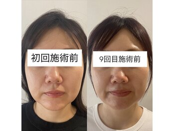 リアプア(Li'a)/8回での変化 リフトアップ