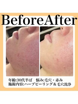 スイ(sui)/Before&After