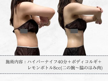 エメ 名古屋栄店(aimer)/レモンボトル<痩身・脂肪分解>