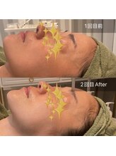 リムビューティー 自由が丘(RymBeauty)/くすみ・ごわつき[ダクトピール]