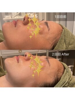 リムビューティー 自由が丘(RymBeauty)/くすみ・ごわつき[ダクトピール]